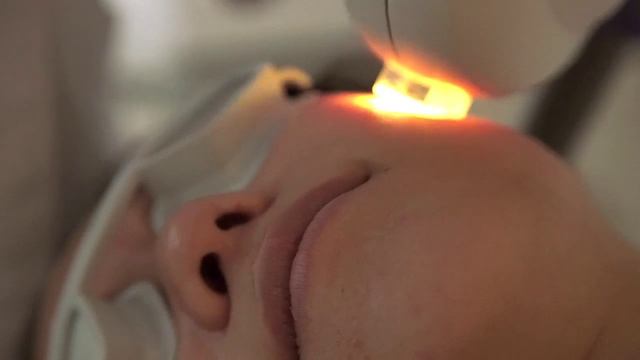 IPL Photofacial with Lumenis M22 at Trifecta Med Spa смотреть онлайн