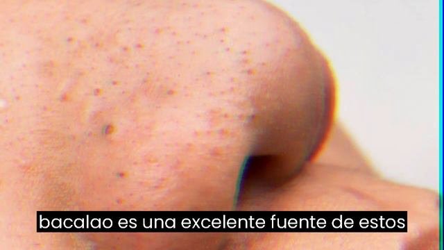 Cómo Deshacerse De Los Puntos Negros Y Los Filamentos Sebáceos   Dr  Iceberg