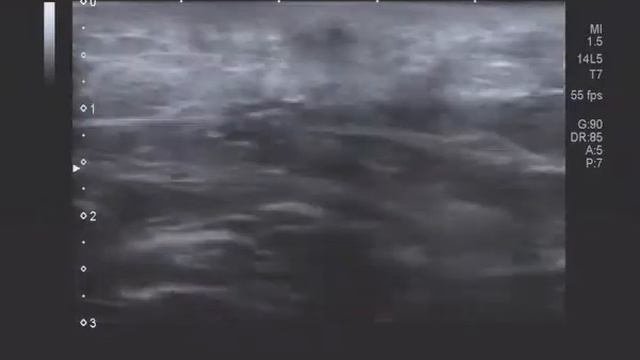Зона размозжения мягких тканей на УЗИ