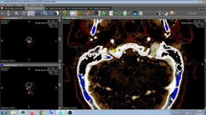 КТ АНГИОГРАФИЯ ШЕИ И ГОЛОВЫ .