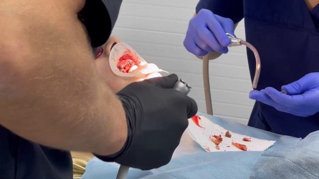 Протезирование по технологиии all on 6 смотреть онлайн