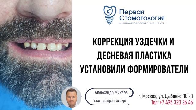 Я стесняюсь своих зубов. Эмоции от новой улыбки. Имплантация зубов.