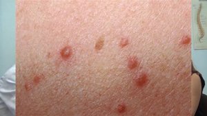 Как лечить угревую сыпь на различных участках тела