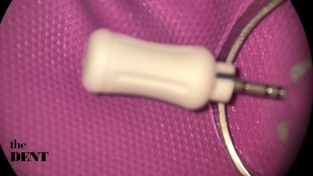 Эффективное эндодонтическое лечение каналов с использованием ручных инструментов