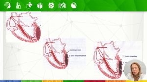 ЭКГ - диагностика ишемии и острого инфаркта миокарда