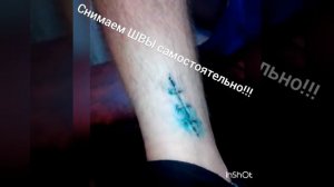 Как снять хирургический шов дома?