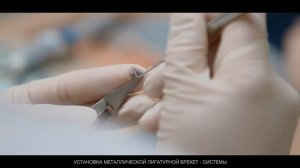 Установка металлической лигатурной брекет-системы