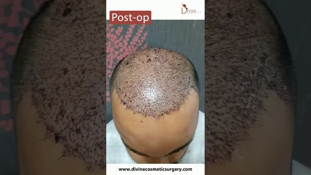 12000 Follicles Hair Transplant 1 Year 2023  #hairtransplantresults #hairtransplantindia #newshorts