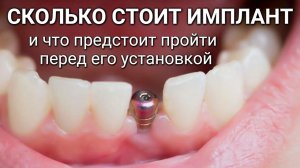 СКОЛЬКО СТОИТ ЗУБНОЙ ИМПЛАНТ и что предстоит пройти перед его установкой