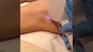 Laser Hair Removal