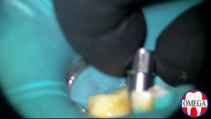 Извлечение фрагмента сломанного абатмента из импланта.