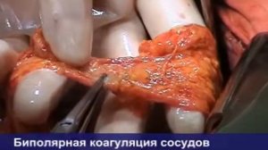 Резекция тонкой кишки