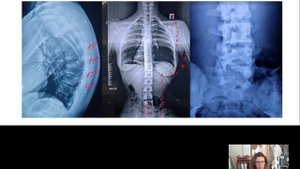 Болезнь Шейрмана-Мау: чем отличается от обычной сутулости?