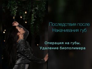 Последсвия некачественного увеличения губ. Мой опыт. Удаление биополимера из губ, операбельно.