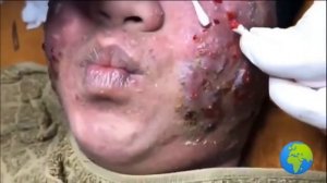 24# Все лицо один большой прыщ!