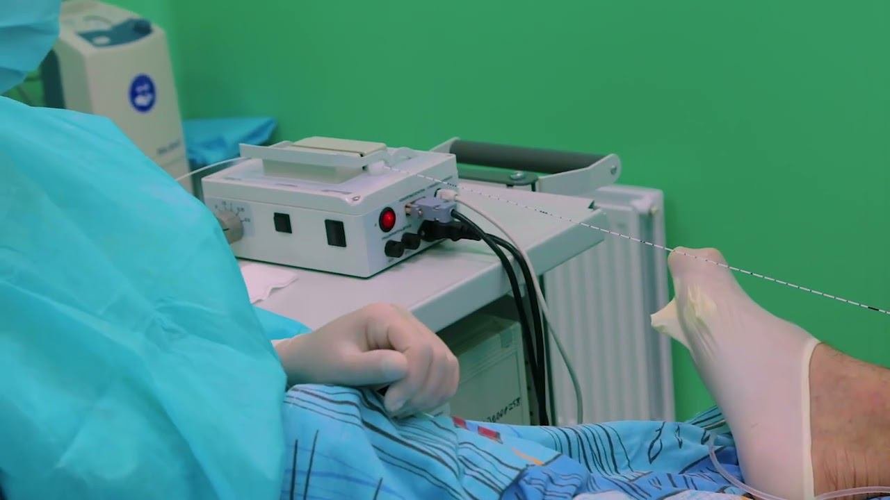 Эндовенозная лазерная коагуляция