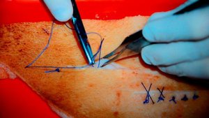 Cosmetic skin suture #2 Шов Холстеда (косметический шов), выпуск 16. 1080р!