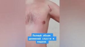 Рефиксация большой грудной мышцы