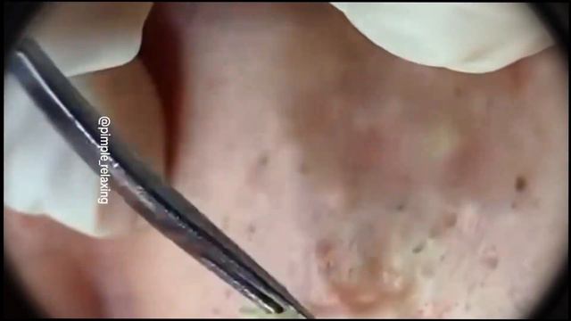 Удаление прыщей /  Чистка кожи от угрей / прыщи / Акне /  skincarе / asmr  / Acne Treatment / pimpl