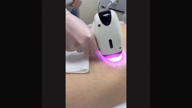 Диодная эпиляция в салоне "Чёрный лис" смотреть онлайн