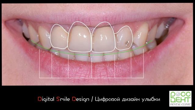 Замена металлокерамических коронок на цельнопрессованную керамику Е. Max Ceram смотреть онлайн