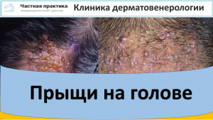 Прыщи на голове