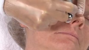 Процедура на аппарате ICG Skin Renovation