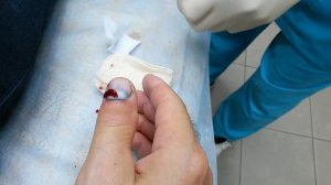 Лечение гематомы под ногтем