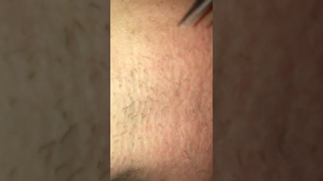 В после волосся. Видалення волосся з коренем. Депіляці. смотреть онлайн