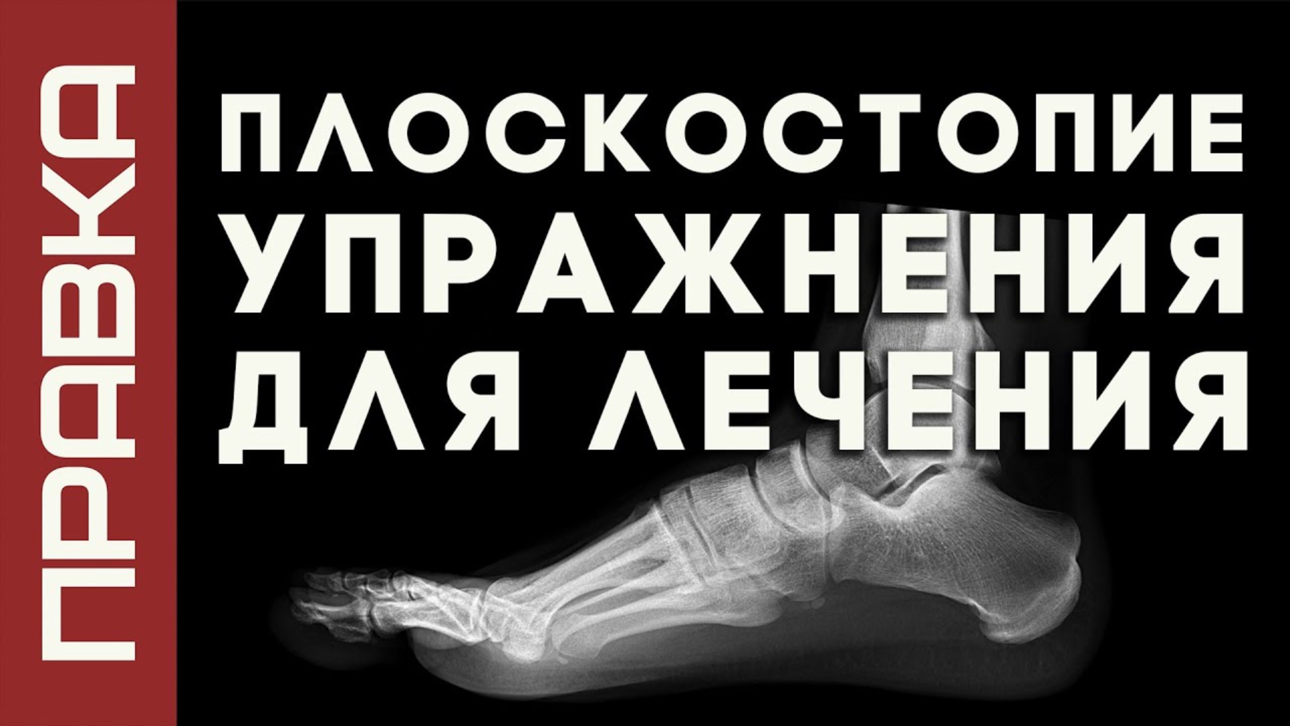 Упраженения для лечения плоскостопия