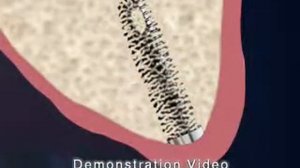 Балочная конструкция на зубных имплантантах