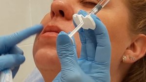 АирисКом; обучение. Коррекция АСИММЕТРИИ ГУБ (Princess Filler 1мл)