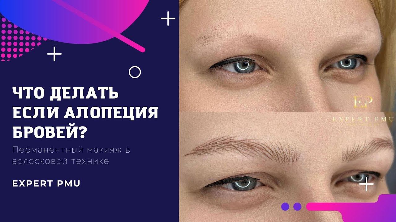 Алопеция бровей? Реконструкция бровей
