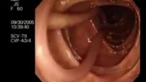 Круглые Черви - Аскариды (колоноскопия) - Аскаридоз: симптомы,лечение,профилактика,признаки