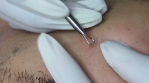 Чистка Кожи у Косметолога. Выдавливание Прыщей. Удаление Черных Точек и Угрей. 2022 - №6