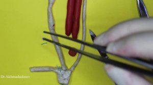 Пластика пахового канала по Мартынову