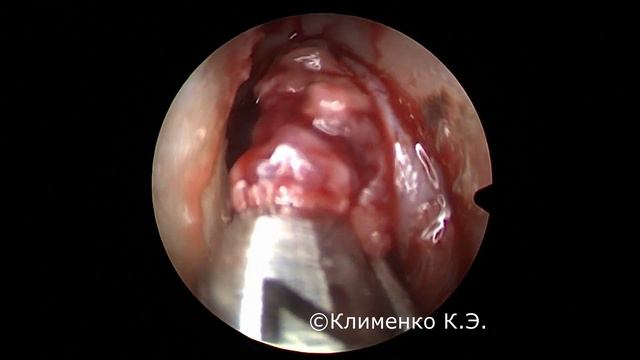 Расширенная эндоскопическая фронтотомия. Extended frontal sinusotomy. смотреть онлайн