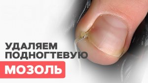 ПОДНОГТЕВАЯ мозоль | Как удалить?