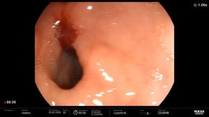Endoscopic Treatment of Upper Gastrointestinal Ulcer Bleeding. Forrest IB/ Язвенное кровотечение