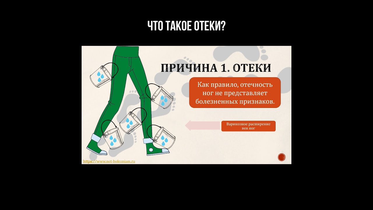 Что такое отёки? смотреть онлайн