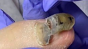 ОНИХОГРИФОЗНЫЙ ноготь????❗️ • Зачистка??