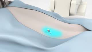 Lumbar Sympathetic Block смотреть онлайн