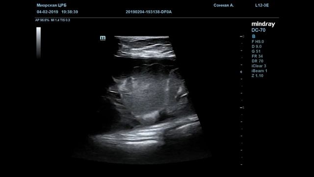 Серома над ПХВ сеткой смотреть онлайн