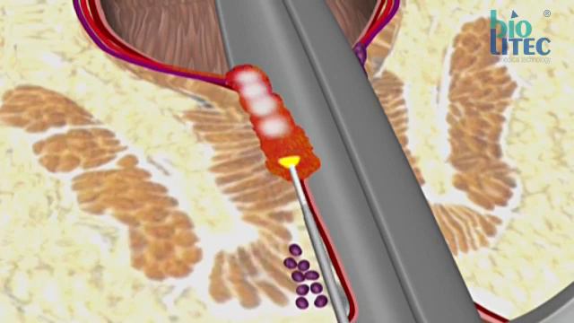 Лазерное удаление геморроя  LHP смотреть онлайн