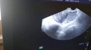 УЗИ органов малого таза. Эндометриоидная киста