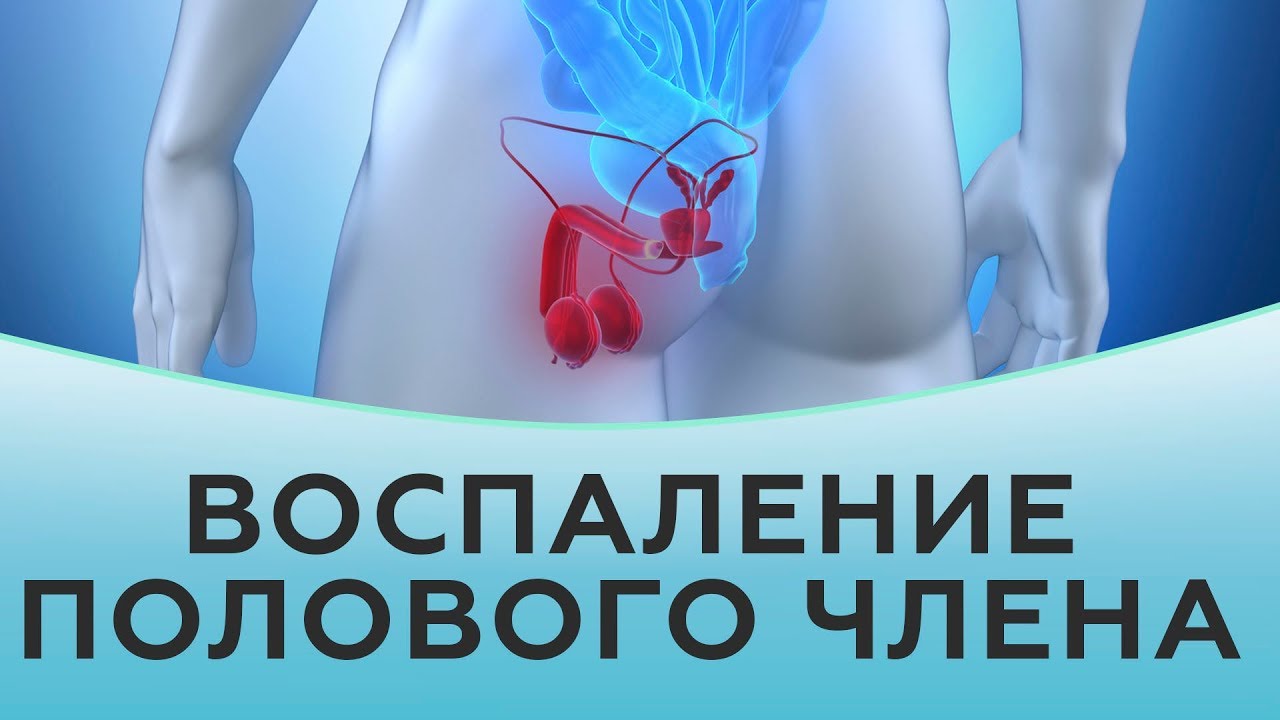 Воспаление полового члена.