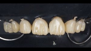 Композитные виниры.  Трансформация клыков в резцы. Виниры до и после. Composite veneers.