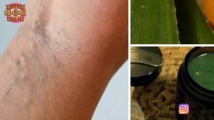 "Легкость в ногах"! ХОЗЯЙСТВЕННОЕ МЫЛО от ВАРИКОЗА!