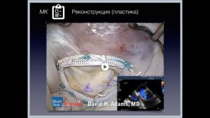 ППС-3-МН