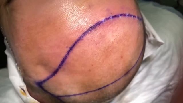 Saç Ekimi Yaptırdım - Bilmeniz Gereken Her Şey (En Kapsamlı Video) смотреть онлайн